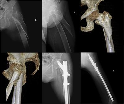 Augmentation of intramedullary nail in unstable intertrochanteric fractures with plate or cable